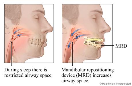 Alternatives to shop cpap machine